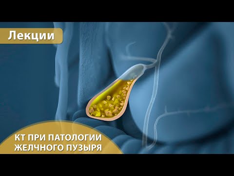 Компьютерная томография при патологии желчного пузыря. Андрей Мангов