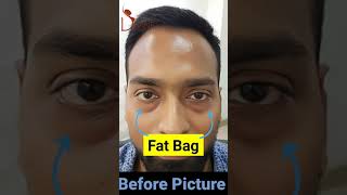 Lower Blepharoplasty | Under Eyes Bag Surgery | Puffy Eyes