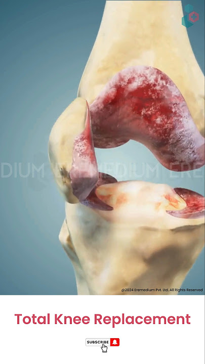 Total Knee Replacement Surgery ↪ 3D Medical Animation #Shorts #KneeReplacement #Knee