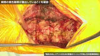 動画9　頚椎症性脊髄症／頚椎後縦靱帯骨化症に対する頚椎椎弓形成術（両開き式）