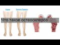 Что такое остеосклероз
