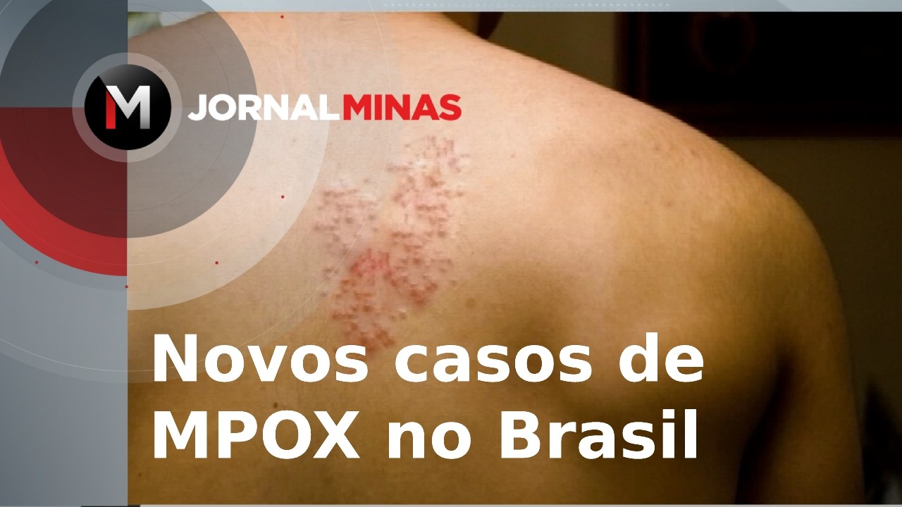 Novos casos de MPOX no Brasil - Jornal Minas