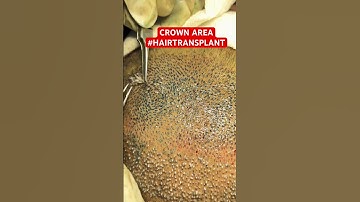 CROWN AREA HAIR TRANSPLANT #hair #crown #hairloss #ytshorts #shorts #hairstyle #drpranilmore