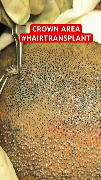 CROWN AREA HAIR TRANSPLANT #hair #crown #hairloss #ytshorts #shorts #hairstyle #drpranilmore