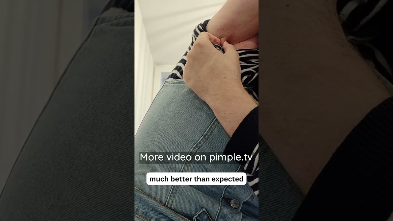 Never Squeeze Acne With Your Hands 