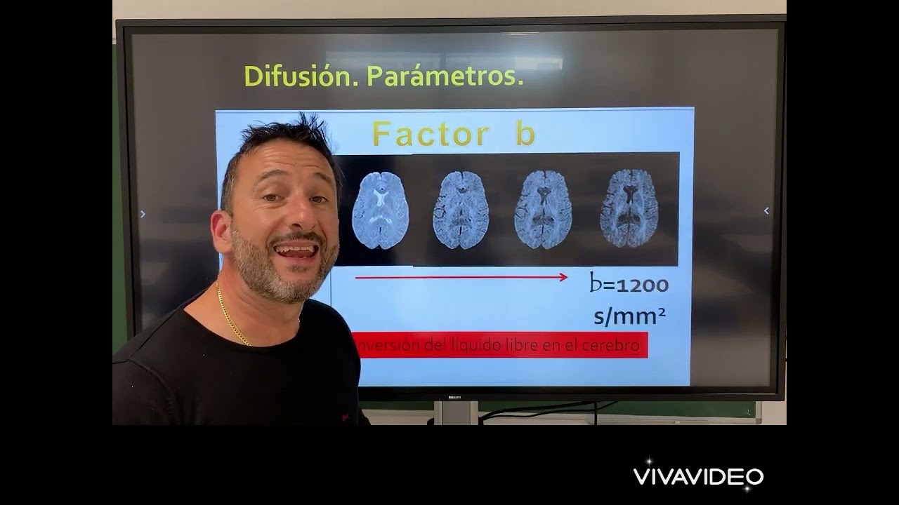 Difusión en Neuro Rm. Aspectos físicos y aplicaciones clínicas.