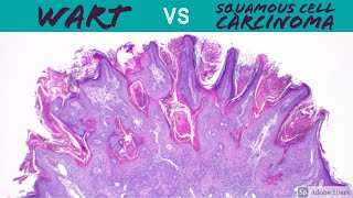 Wart vs Squamous Cell Carcinoma (Dermpath Pathology Dermatology Verruca Seborrheic Keratosis SCC) screenshot 5