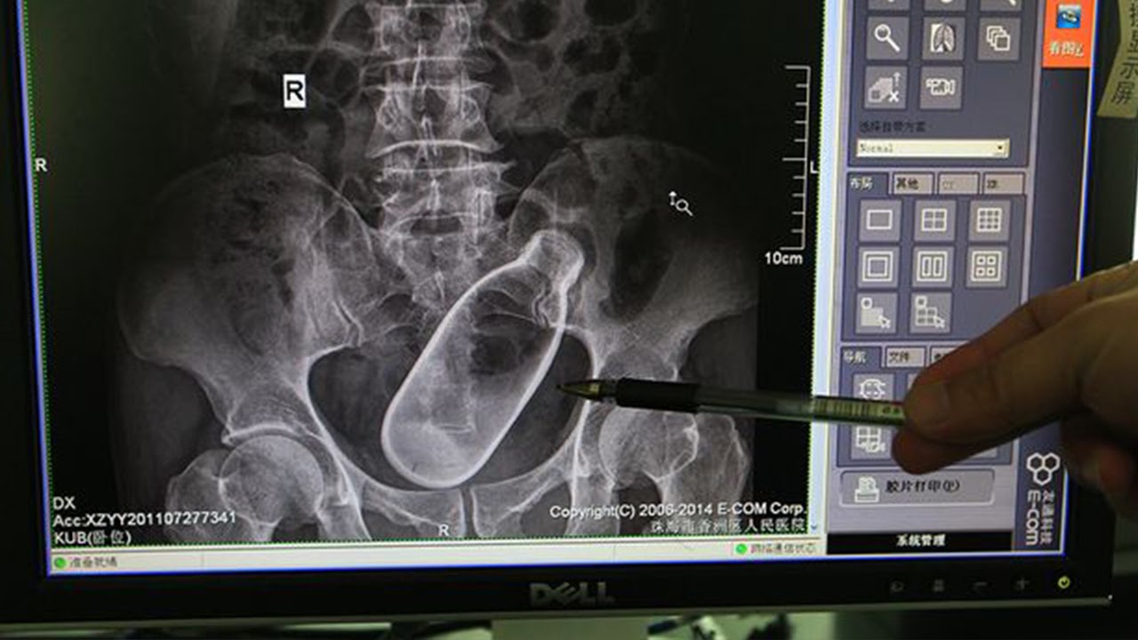 X-Rays Reveal Bottle Stuck Inside Man - YouTube