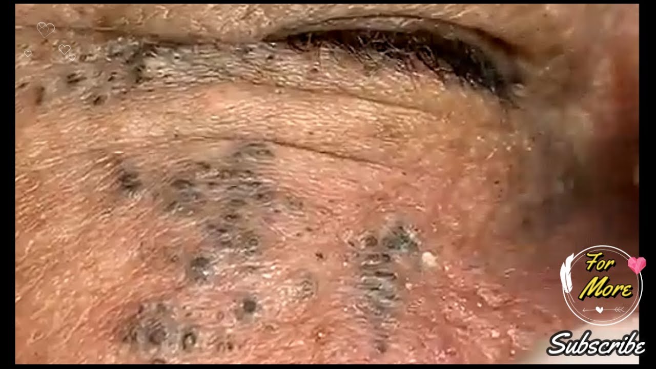 Dr Pop Deep Blackheads In Old Skin Removing And Treatment 2020 Part 5