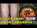 红豆加它是滑膜炎的“救命藥”，不出2周，膝蓋不疼了，滑膜炎積液也拜拜了！快速解除膝關節疼痛發炎