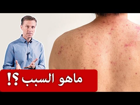 حساسية الجلد بسبب الماء | ماهو السبب والعلاج