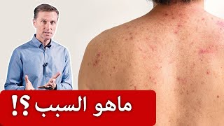 حساسية الجلد بسبب الماء | ماهو السبب والعلاج