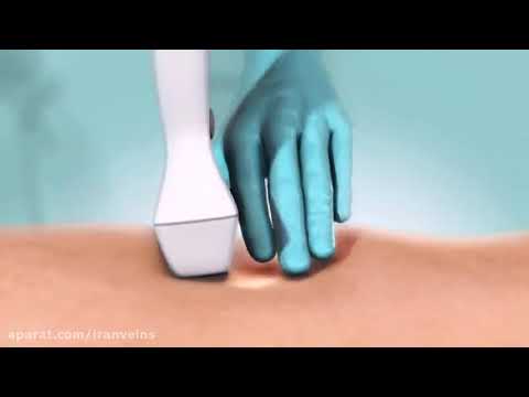 چسب واریس درمان واریس شدید