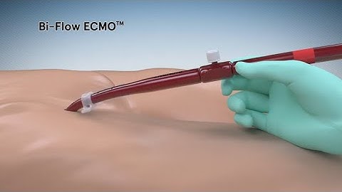 Bi-Flow bidirectional cannula. Medical device animation by Aarons CGI 3D animation studio Melbourne