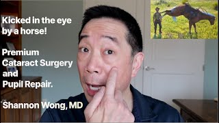Kicked in the eye by a horse!  Pupil repair and premium cataract surgery.  Shannon Wong, MD