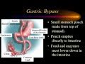 Introduction to Bariatric Surgery