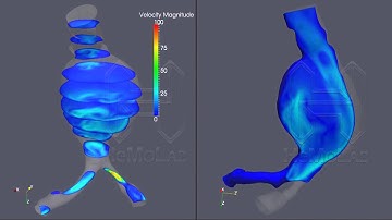 Blood flow - Abdominal aortic aneurysm