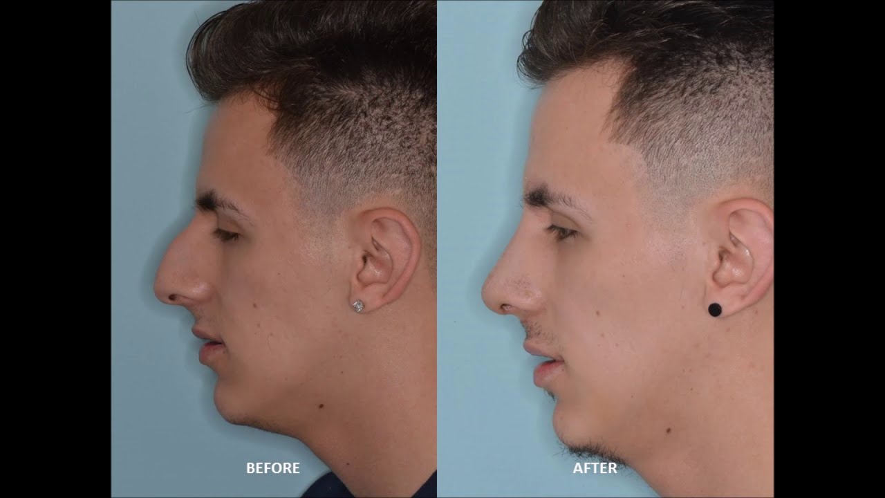 Male Rhinoplasty for an Overprojected Tip and Bridge | Anthony Bared, MD, FACS Miami, FL
