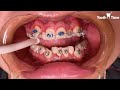 Braces On - Molar Bands - Tooth Time Family Dentistry