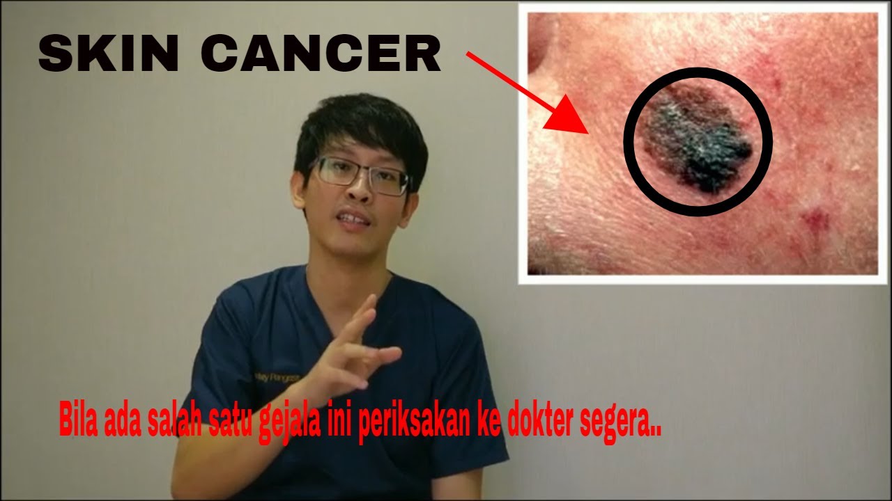Cara mendeteksi kanker kulit secara dini dengan mengenali ciri-cirinya