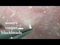 鼻角栓107.2nose blackheads（Larger version）★Tweezers only★
