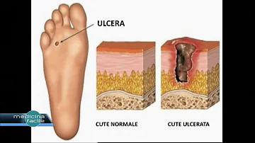 Come curare un'ulcera diabetica al piede?