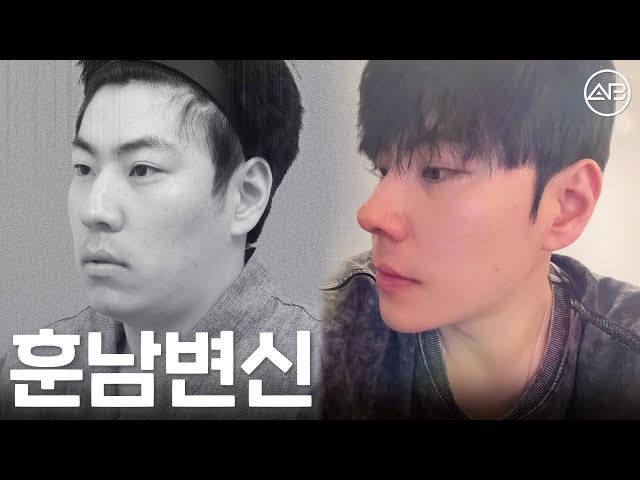 Gen Z들이 성형하는 법: 훈남친구따라 코랑 윤곽수술하기 | 후기있음 | 에이비성형외과