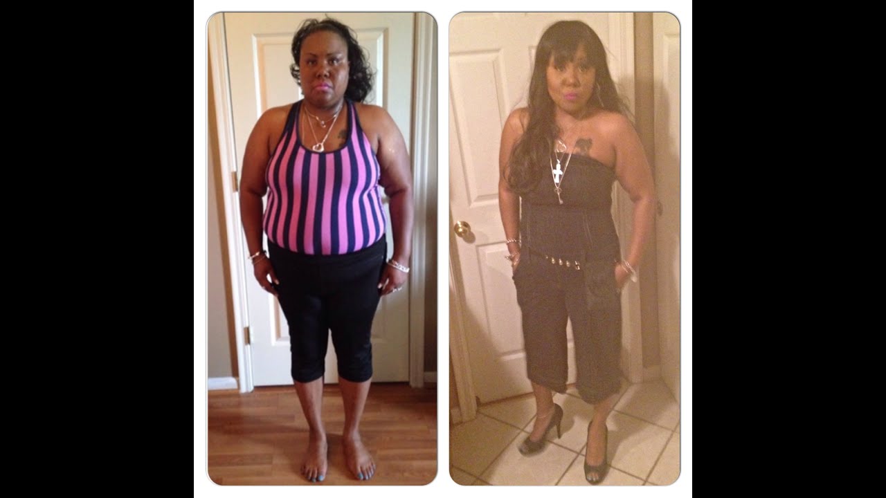 11 Mo w/Video PanniculectomyWhat!? Plastics Update & Waist