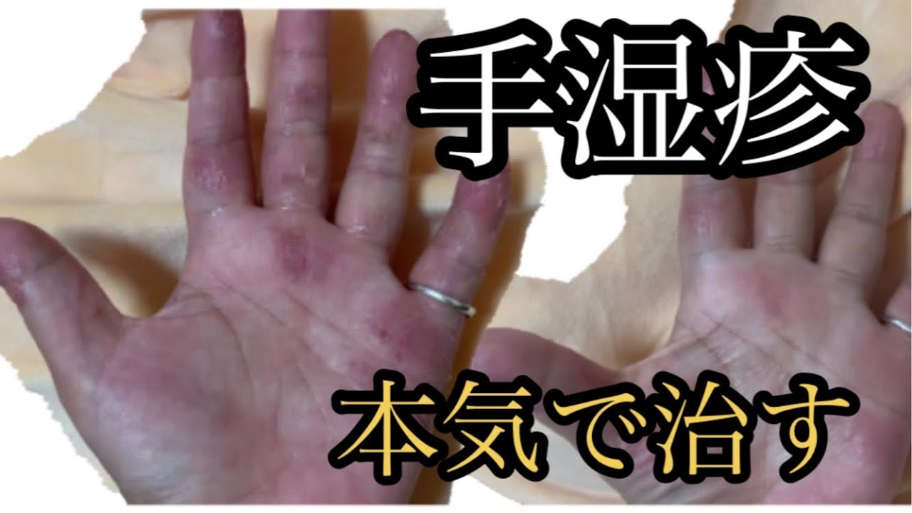 手湿疹 本気で治す 手荒れを治す方法 Youtube 手湿疹 本気で治す 手荒れを治す方法 Youtube