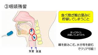 摂食・嚥下障害の基礎と誤嚥を防ぐ方法