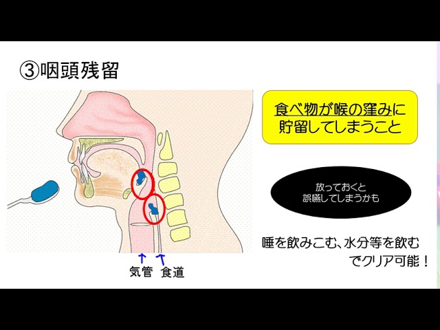 成人・高齢者の摂食嚥下リハビリテーション - YouTube