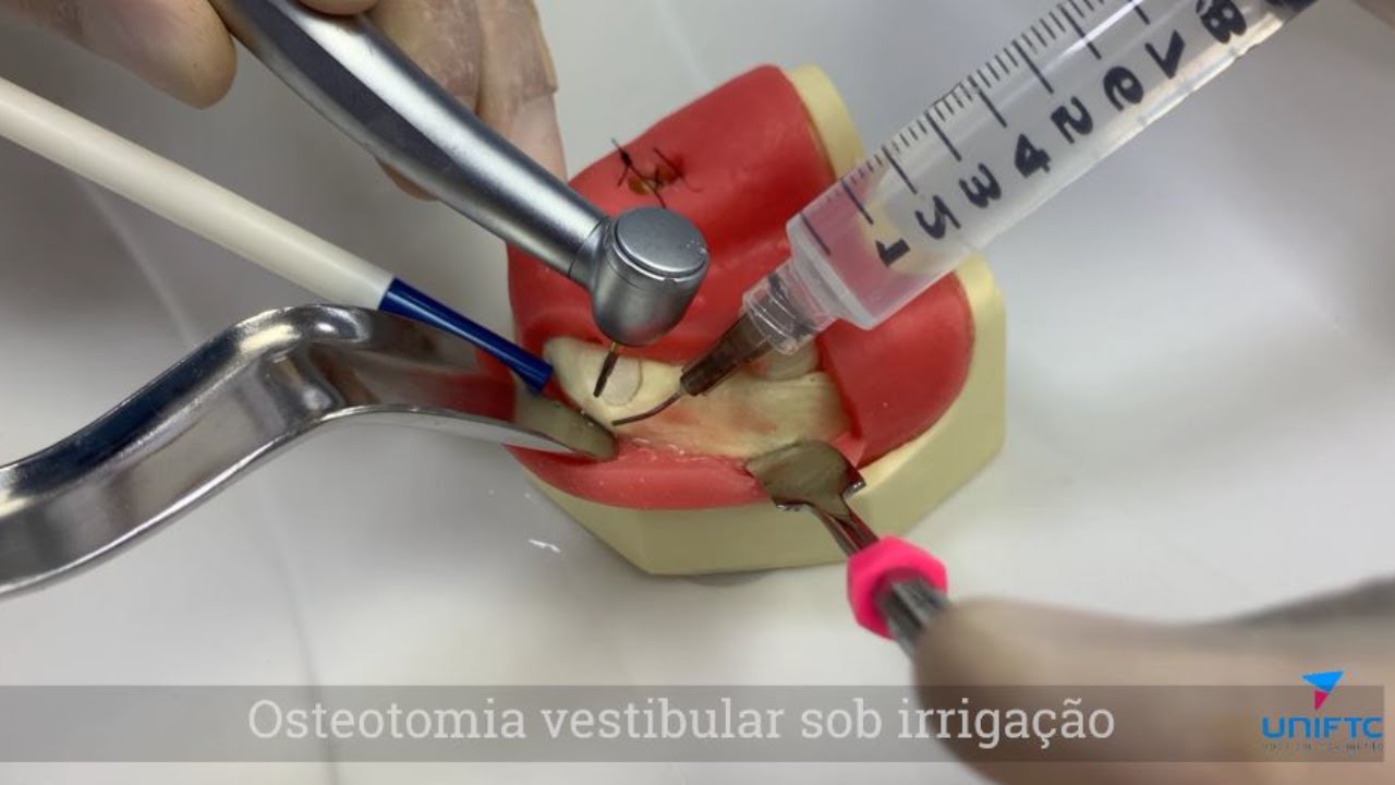 Simulação de remoção de raiz residual inclusa em manequim odontológico
