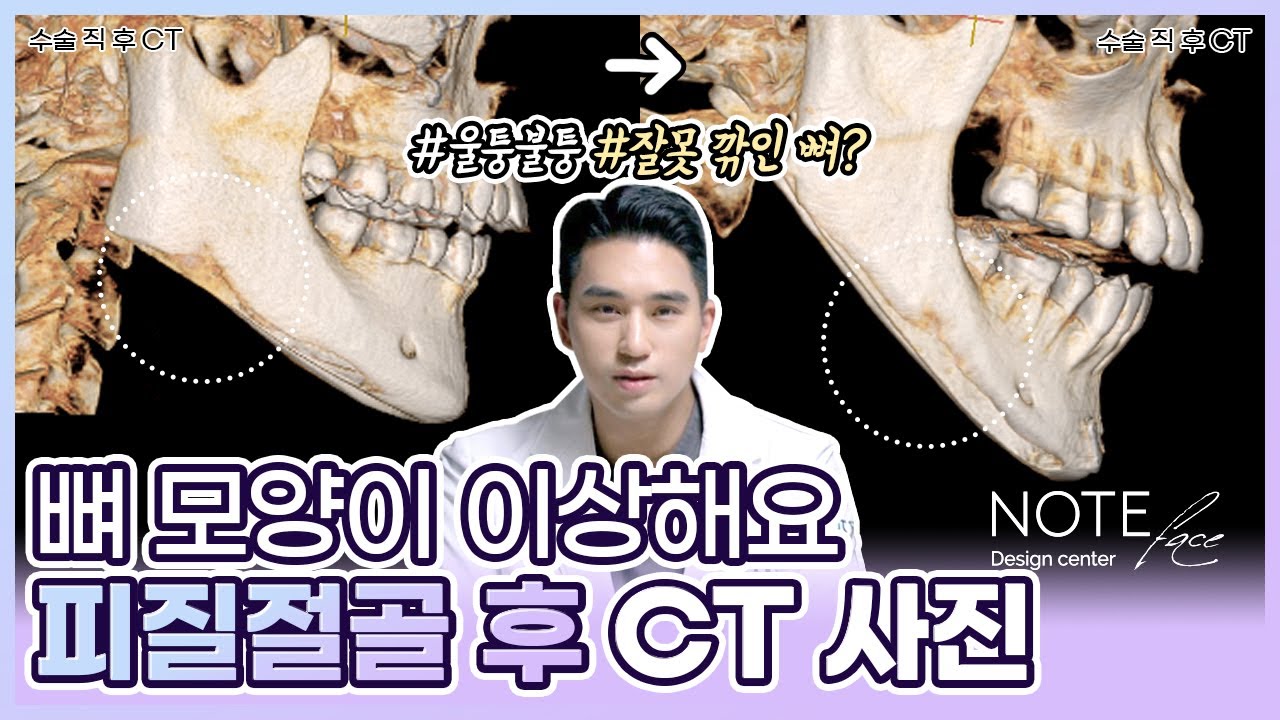 [유.케.리] CT로 보는 케이스 리뷰 l 피질절골이 뭔가요? l CT 뼈 모양이 이상해요  l 윤곽 후 다시 자라난 뼈? l