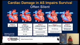 Clinical Impact of "Moderate" Aortic Stenosis and the Potential Benefit of Therapy