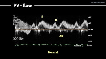〖Echocardiography〗 Diastolic dysfunction X - Scoring in DD, PV signal & stress test 🚴🏼‍♂️🫀
