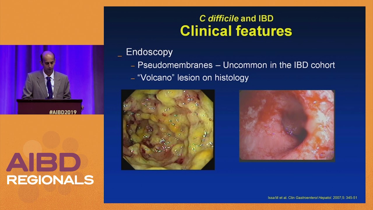 Prevention And Management Of C Difficile Colitis YouTube