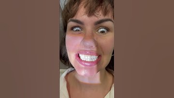 The moment we’ve all been waiting for #dentalimplant #implantsurgery #teeth #implants #smile