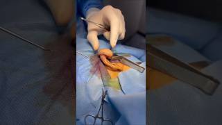 Removing Keloid Cyst under Local Anesthesia. #Keloid #Cyst