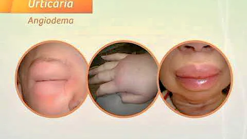 Quais são as causas mais relatadas na alergia alimentar?