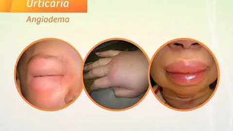 Como diminuir inchaço causado por alergia?