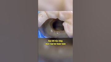Quy trình điều trị tuỷ răng