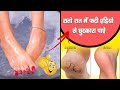 1 ही रात में फटी एड़िया से छुटकारा पाए! Cracked Heels Home Remedy   Cracked Heels Treatment