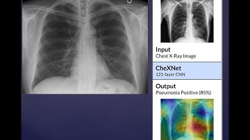 Machine Learning Algorithm Diagnose Pneumonia | CheXnet
