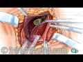 Education Hernia Repair Inguinal (Open) PreOp® Patient Surgery