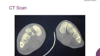Lisfranc Injuries of the Foot by Dr Peter Moore