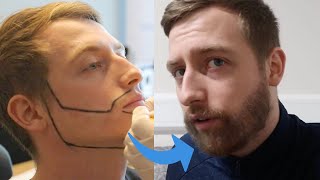 Beard Transplant - Jay´s Complete journey to a Full Beard (before / after)