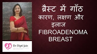 FIBROADENOMA BREAST  ब्रैस्ट में गाँठ कारण, लक्षण और इलाज / Dr Dipti Jain Ahmedabad