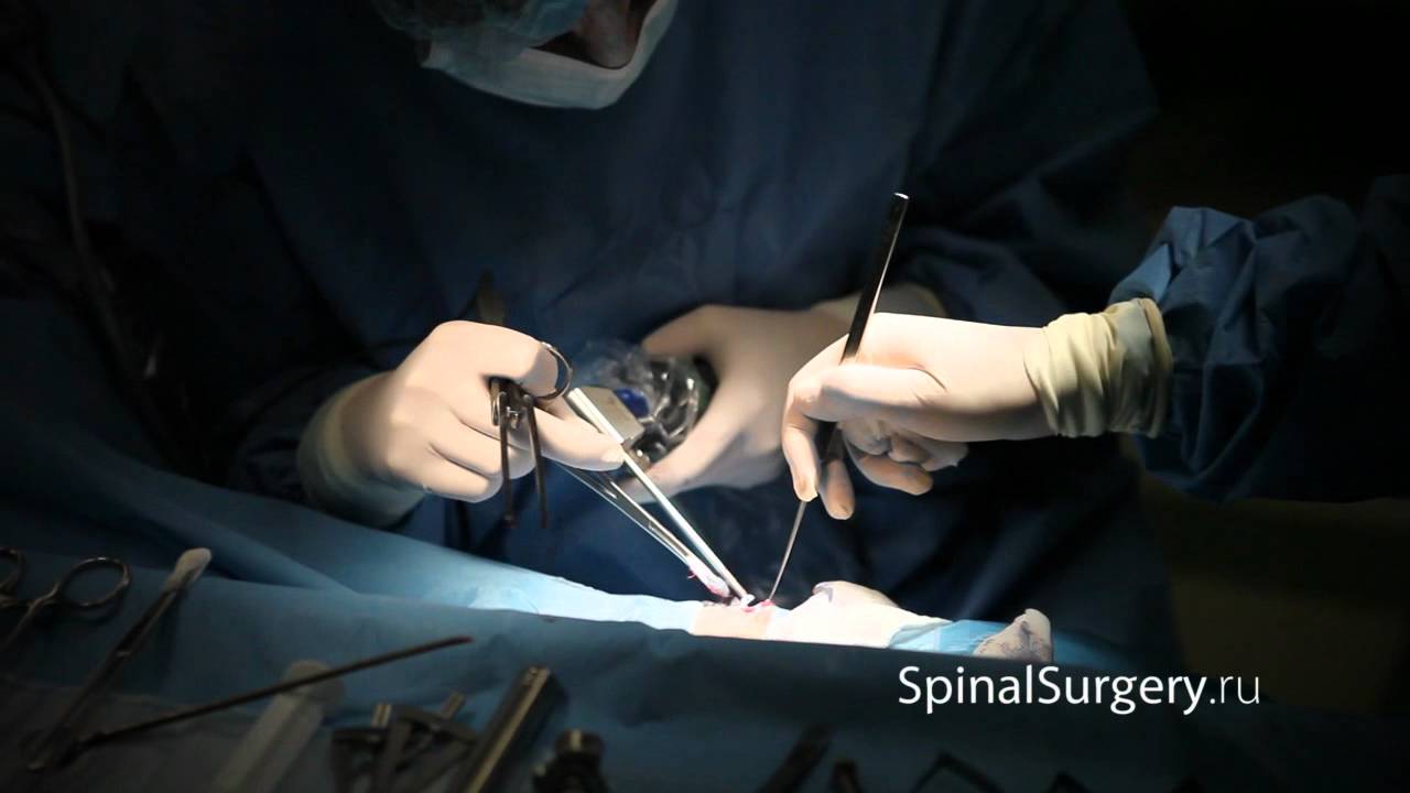 Лечение карпального туннельного синдрома - YouTube