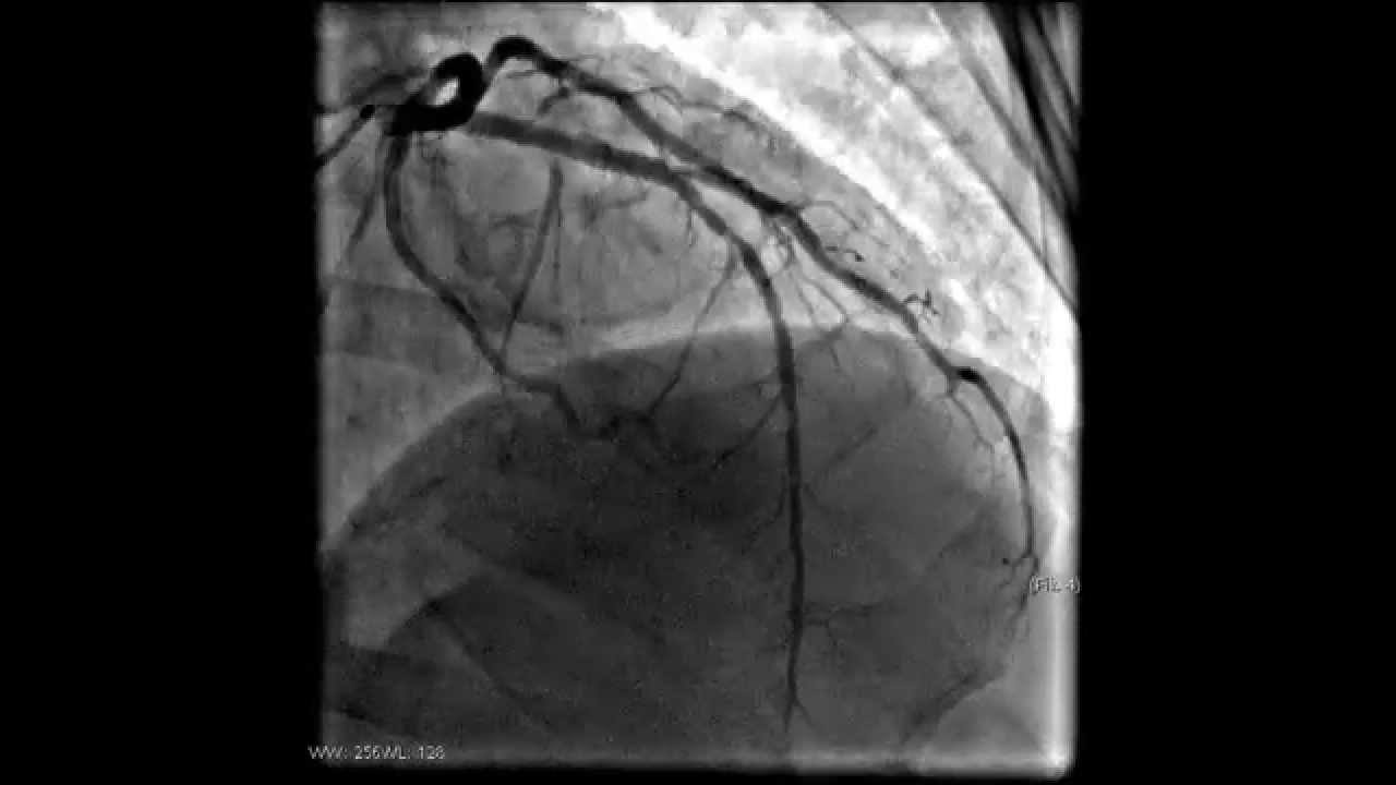 Селективная ангиография сосудов сердца - YouTube