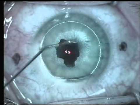 lasik eye